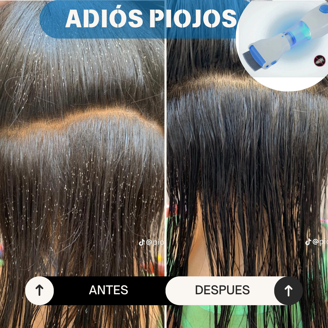 ¡ADIÓS PIOJOS PARA SIEMPRE! – LA SOLUCIÓN MÁS EFECTIVA Y SIN QUÍMICOS